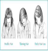 Hair Loss due to thyroid &#8211; What You Need to Know