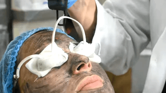 Carbon Facial Procedure at AK Clinics