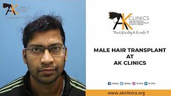 MR. KASHIV AFTER 2ND HAIR TRANSPLANT SESSIONS - AK CLINICS